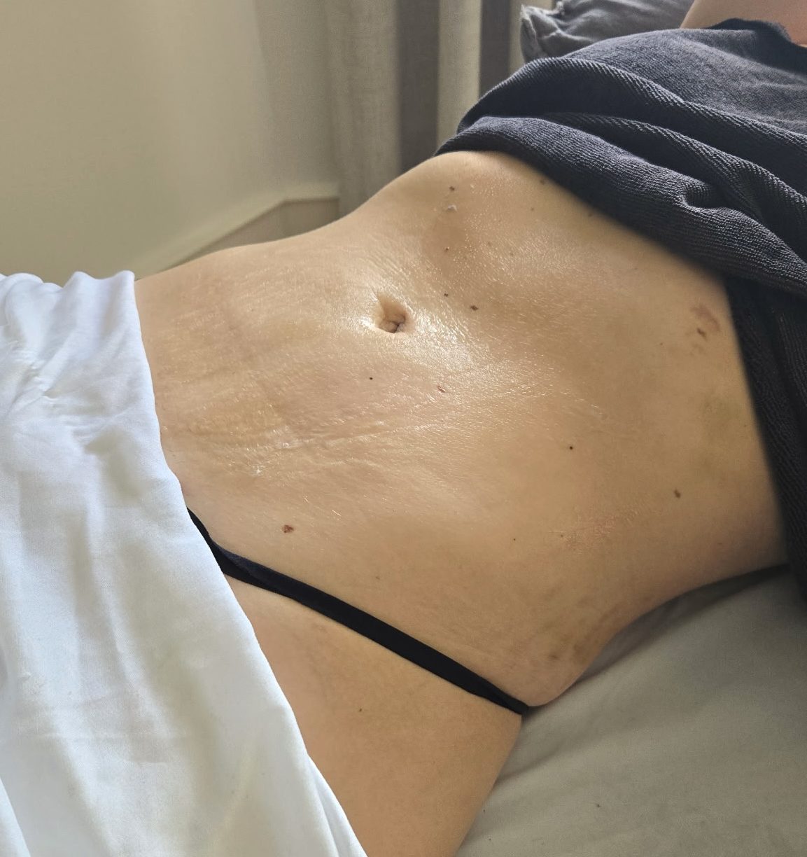 post-op lymphatic drainage
