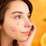vitamin c and acne