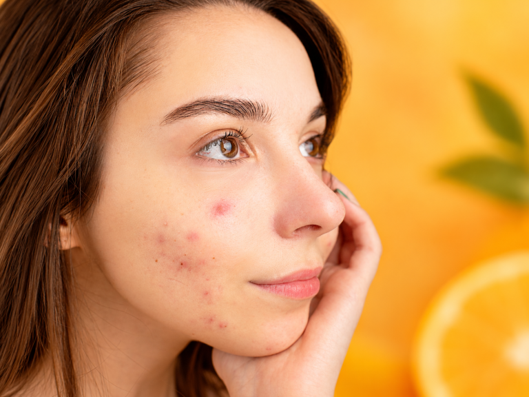 vitamin c and acne