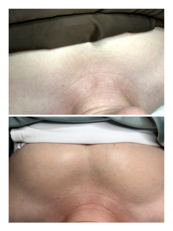 BioRePeel before and after - 1