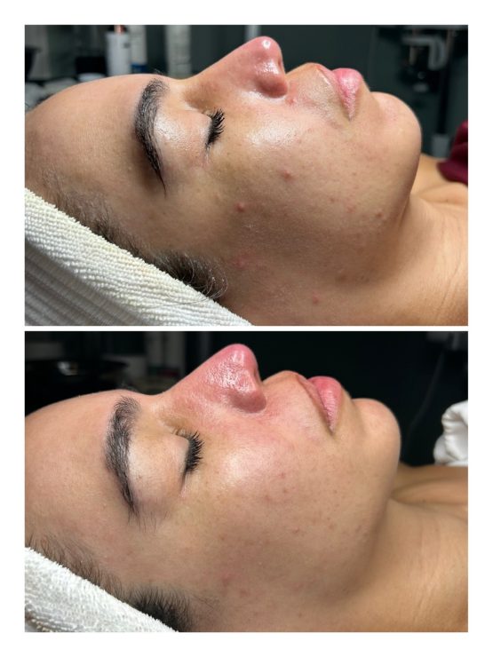 BioRePeel before and after 2